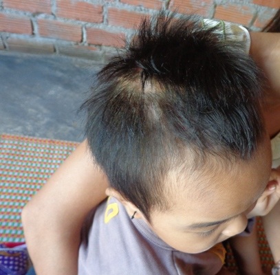 Vết mổ đã liền sẹo nhưng không có tiền chưa trị nên tiếp tục tái phát