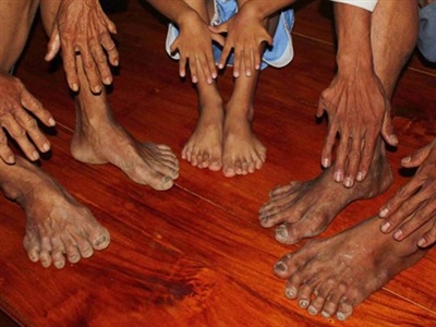 Tất cả các bàn tay và chân những người này đều có 6 ngón.