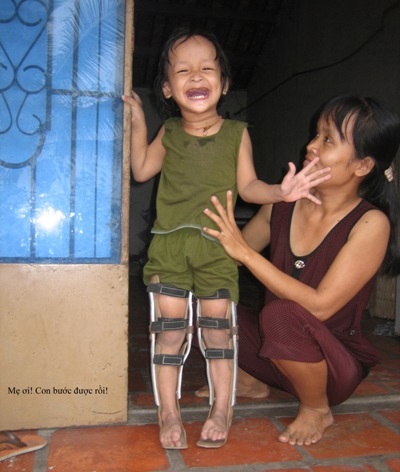 Thay đổi cuộc đời nạn nhân chất độc da cam - 1 Bé Trang Thanh Trà cười tươi rạng rỡ vì đã có thể tự đứng trên đôi chân được bó nẹp của mình