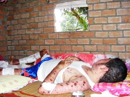 Thiếu thốn thuốc thang, nên cơ thể của Triệu lỗ chỗ những vết thương rớm máu đang dần “phân hủy”