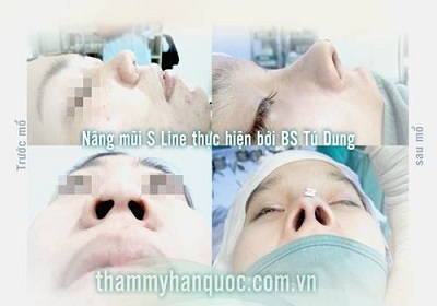 Nâng mũi S Line Hàn Quốc - 5 Tất cả các dịch vụ thẩm mỹ tại Thẩm mỹ Hàn Quốc JW luôn có thẻ bảo hành.