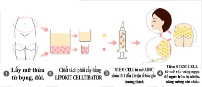 Nâng ngực, độn mông không dùng túi - 2 Nâng ngực, nâng mông an toàn bằng Stem Cell từ mỡ của chính mình.