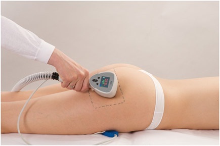 Công nghệ giảm béo toàn thân thế hệ mới - 4 Điều trị giảm mỡ vùng mông và đùi với công nghệ Exilis