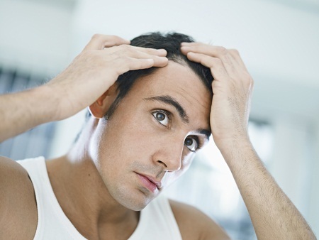 Hormone DHT gia tăng: Thủ phạm hàng đầu khiến nam giới rụng tóc - 1 95% các trường hợp rụng tóc ở nam giới là do sự gia tăng DHT
