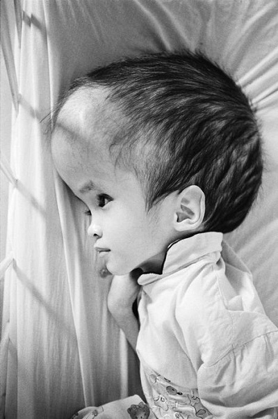 Hình ảnh Việt Nam mạnh mẽ sau chiến tranh - 26 Một em bé bị nhiễm chất độc màu da cam.