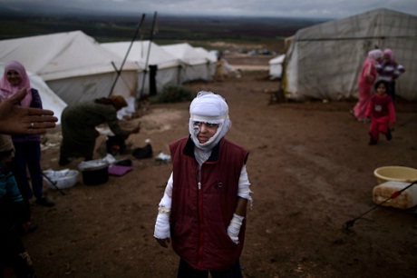 Cậu bé Abdullah 10 tuổi bị bỏng nặng sau một cuộc không kích của quân đội Syria.