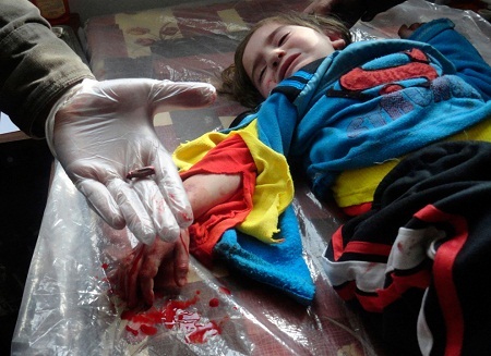 Một em bé người Syria bị đạn lạc găm vào bàn tay, em được đưa tới bệnh viện dã chiến để phẫu thuật.