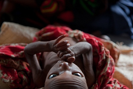 Một em bé đang trong tình trạng suy dinh dưỡng nặng ở trại tị nạn Dagahaley, Kenya.