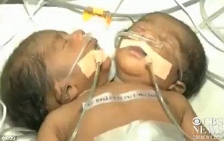 Các bác sĩ ở thành phố Jaipur, bang Rajasthan, Ấn Độ tin rằng họ có thể cứu được hai cậu bé.