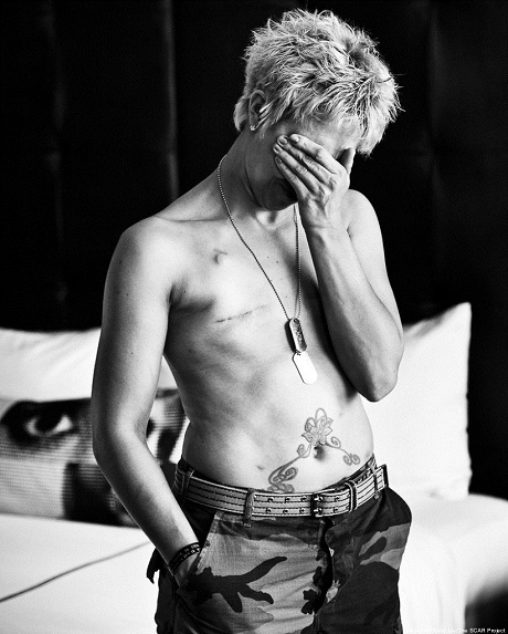 Trọn bộ ảnh về sự nghiệt ngã của căn bệnh ung thư vú - 1 Trọn bộ ảnh về sự nghiệt ngã của căn bệnh ung thư vú