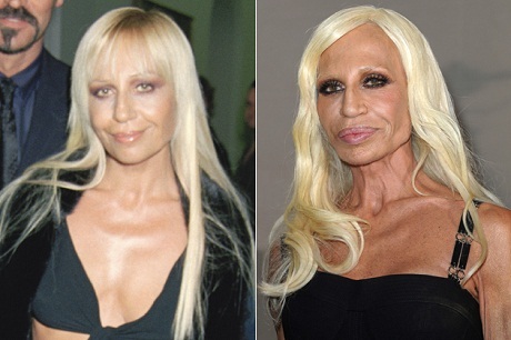 Những nghệ sỹ qua đời vì phẫu thuật thẩm mỹ - 5 Nhà thiết kế thời trang người Ý Donatella Versace:
