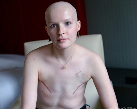 Trọn bộ ảnh về sự nghiệt ngã của căn bệnh ung thư vú - 3 Trọn bộ ảnh về sự nghiệt ngã của căn bệnh ung thư vú