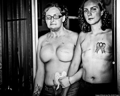 Trọn bộ ảnh về sự nghiệt ngã của căn bệnh ung thư vú - 6 Trọn bộ ảnh về sự nghiệt ngã của căn bệnh ung thư vú