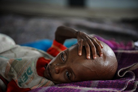 Nhìn để thấy sự khủng khiếp của đói nghèo - 3 Một em bé người Somalia trong trại tị nạn Dadaab (Kenya).