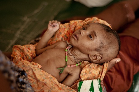 Nhìn để thấy sự khủng khiếp của đói nghèo - 10 Một em bé người Somalia trong trại tị nạn Dadaab (Kenya).