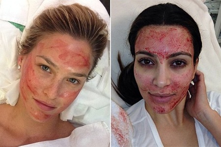 Kinh hãi với trào lưu làm đẹp bằng... máu - 1 Kinh hãi với trào lưu làm đẹp bằng... máu