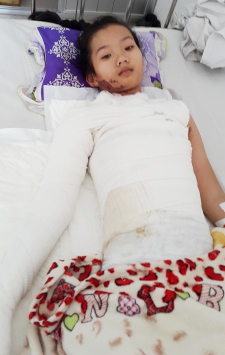 Nữ sinh lớp 10 nguy kịch vì bỏng nặng - 1 Em Lương Kiều Tiên bị bỏng nặng đang nằm điều trị tại BVĐKTƯ Cần Thơ.