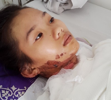 Nữ sinh lớp 10 nguy kịch vì bỏng nặng - 2 Em Lương Kiều Tiên bị bỏng nặng đang nằm điều trị tại BVĐKTƯ Cần Thơ.