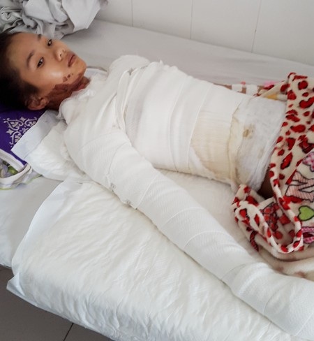 Nữ sinh lớp 10 nguy kịch vì bỏng nặng - 3 Gia cảnh em Tiên rất nghèo nên rất cần sự sẻ chia của các nhà hảo tâm để trị bệnh cho em.