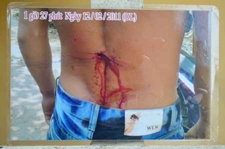 Vết thương trên lưng Lý Hoài Thanh.