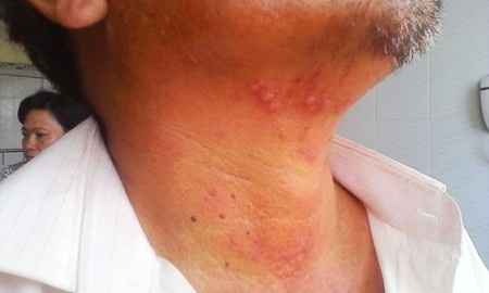 Vết bỏng trên người ông Xuân do bị xịt hơi cay.