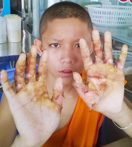 Nghi vấn hai chú tiểu bị bạo hành trong chùa - 2 Vết thương ở bàn tay của chú tiểu Thạch Mai.