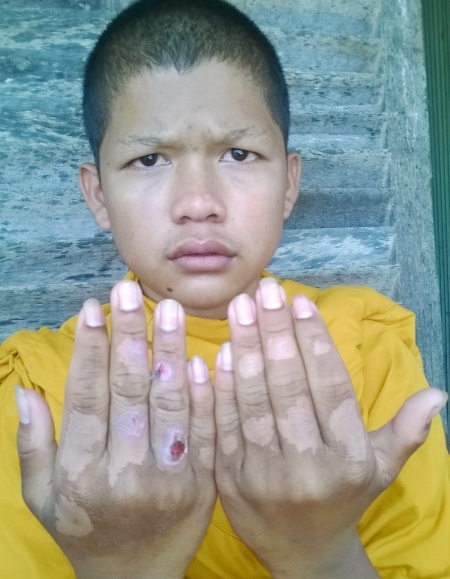 Nghi vấn hai chú tiểu bị bạo hành trong chùa - 3 Chú tiểu Thạch Lộc với hai bàn tay bị bỏng đã tróc da.