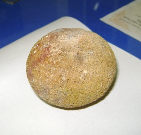 Viên sỏi thận lấy từ người bệnh nhân Minh.