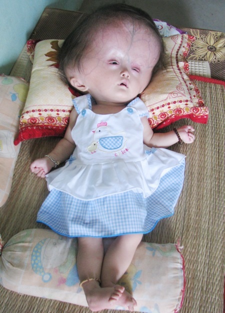 ...và bé Yến với căn bệnh não úng thủy hiện tại.
