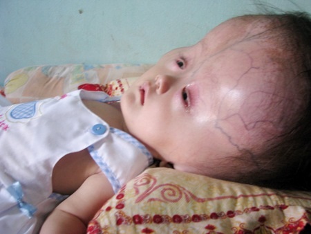 15 tháng tuổi, bé Yến mắc đến 4 căn bệnh hiểm nghèo.