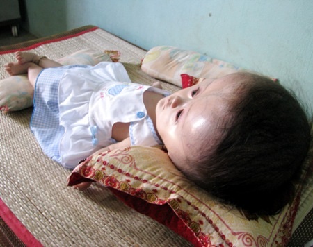 15 tháng tuổi, bé Yến mắc đến 4 căn bệnh hiểm nghèo.