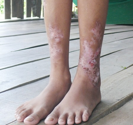 ...rồi lan dần ra ở chân của em.