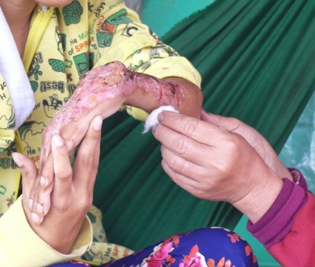 Căn bệnh gây lở loét ở tay...