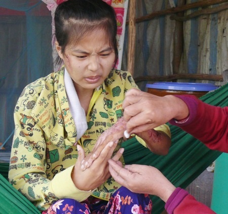 Mỗi lần lau chùi chỗ loét là nỗi cực hình đối với em.