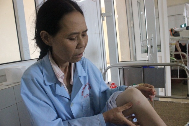 Tay chân chị chằng chịt những vết tim chuyền, kết quả của hàng chục năm sống chung với bệnh