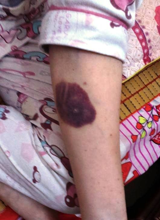 Tóc bị bạc đi và những vết xuất huyết ngày càng nặng