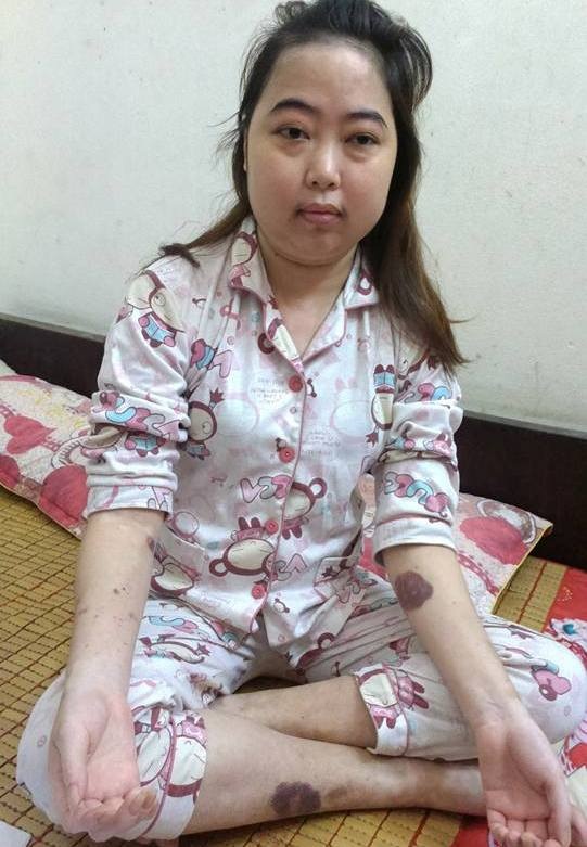 Toàn thân em bị phù nề và xuất huyết