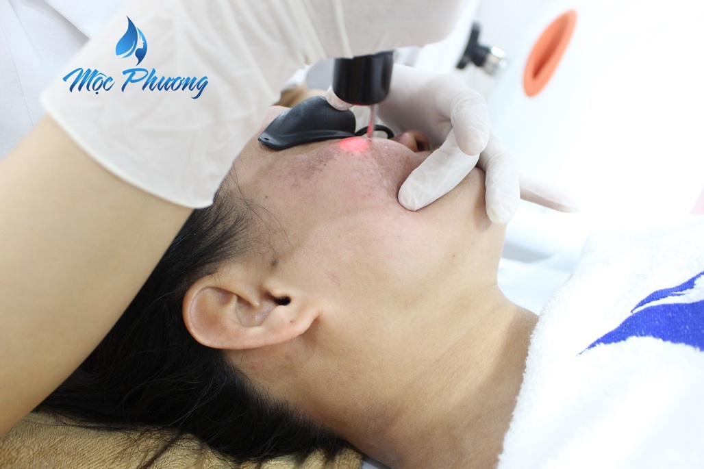 Cơ hội trị nám miễn phí cùng chuyên gia hàng đầu thế giới Andre Steps - 5 Ngay cả những ca bị nám lâu năm, với công nghệ hiện đại và đội ngũ chuyên gia tay nghề cao, Mộc Phương Beauty Salon luôn cam kết hết nám lên tới 95%