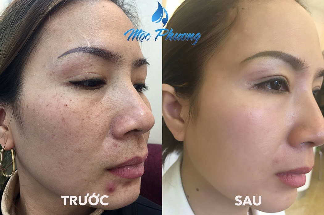 Cơ hội trị nám miễn phí cùng chuyên gia hàng đầu thế giới Andre Steps - 6 Kết quả đạt được sau khi điều trị nám ở Mộc Phương Beauty Salon luôn khiến khách hài lòng