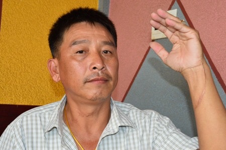 Ông Quách Khánh Tuấn bị đánh gây thương tích đến 22%, nhưng Công an huyện Trần Đề vẫn không khởi tố vụ án hình sự người gây ra thương tích cho ông Tuấn.