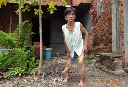 
Thân hình kỳ dị và nỗi đau bệnh tật đang gặm nhấm sự sống của bà
