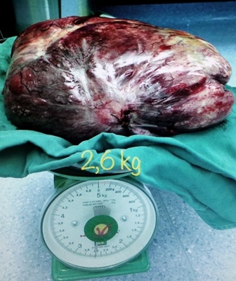 Khối u có trọng lượng lên tới 2,6kg
