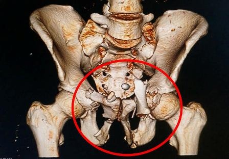Cứu sống nạn nhân bị dập lách, vỡ thận, máu phun thành vòi - 2 Nạn nhân bị gãy dập khung xương chậu phức tạp