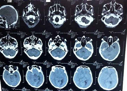 Qua chẩn đoán hình ảnh, bác sĩ xác định bệnh nhân bị máu tụ dưới màng cứng gây chèn ép não