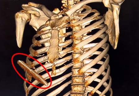 Hình ảnh CT xác định lưỡi dao nhọn đâm thấu lồng ngực nạn nhân