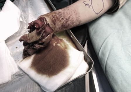 Hình ảnh bàn tay phải của bệnh nhi bị dập nát khi vào cấp cứu tại bệnh viện