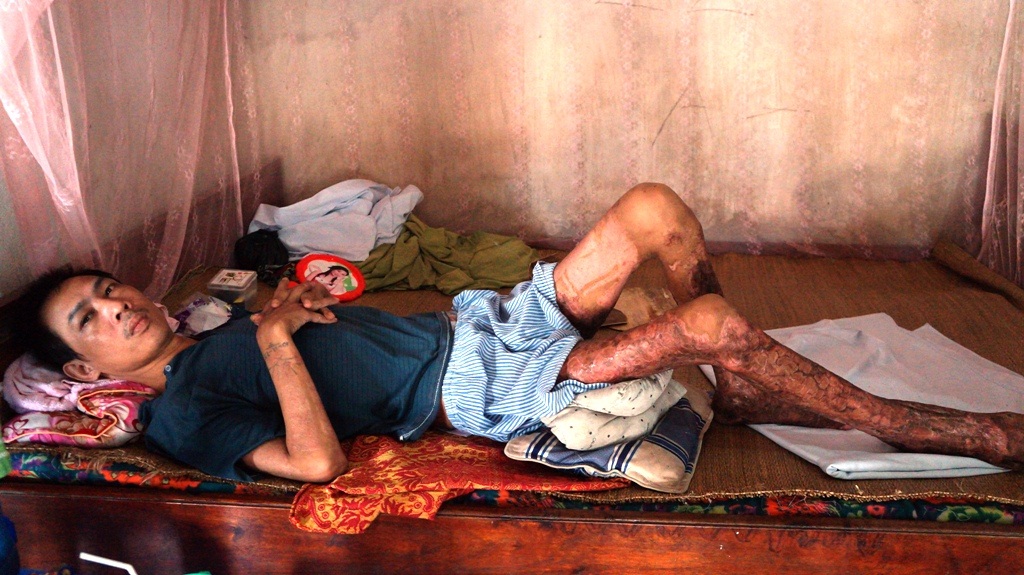 Người đàn ông bị bỏng nặng do bất ngờ ngất xỉu khi đang đốt vỏ ngô - 3
Quá đau đớn anh nằm bất động trên giường.