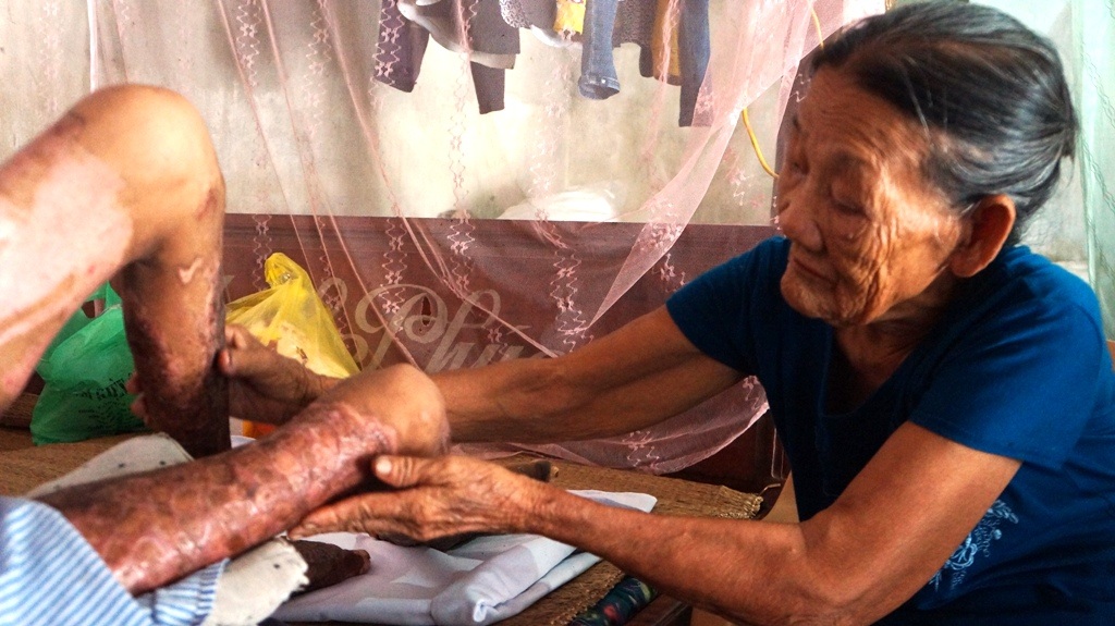 Người đàn ông bị bỏng nặng do bất ngờ ngất xỉu khi đang đốt vỏ ngô - 7 Bà Nguyễn Thị Vận gần 80 tuổi mẹ anh Phương tuổi cao sức yếu hằng ngày vẫn phải chăm sóc con mình.