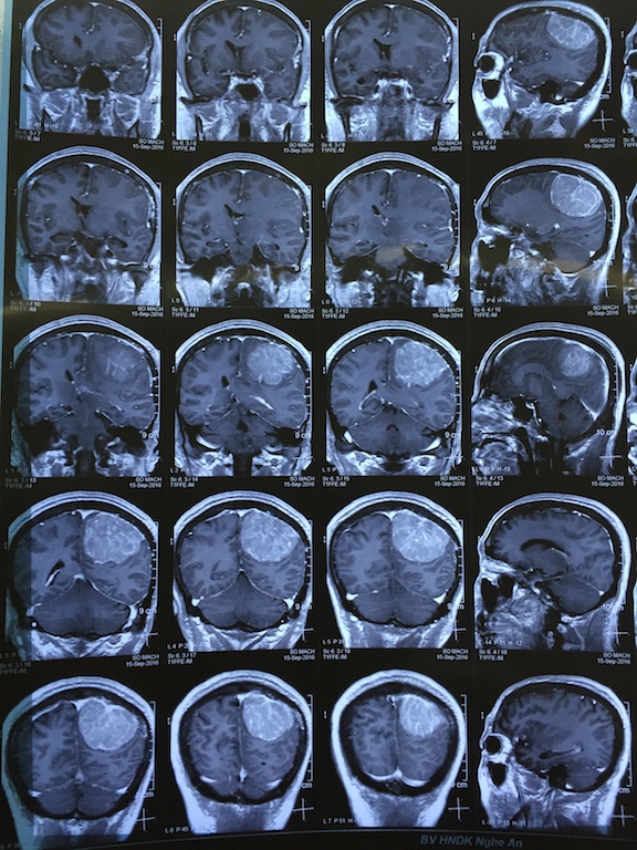 Hình ảnh phim MRI khối u não của bệnh nhân Thường.
