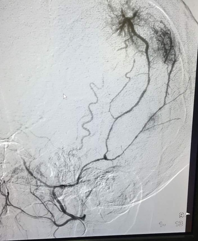 Hình ảnh can thiệp mạch máu nuôi khối u não của bệnh nhân Thương.